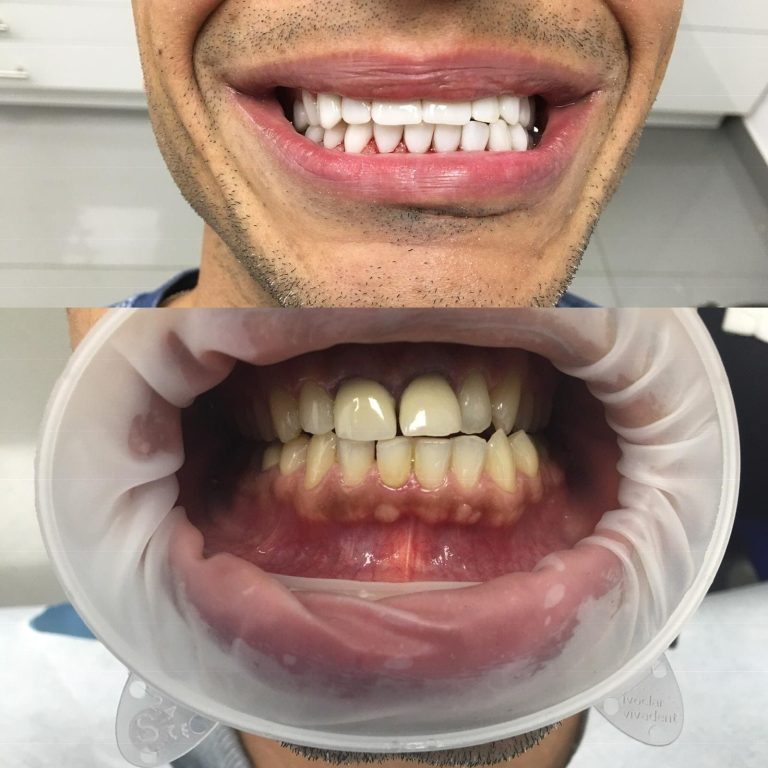 לפני ואחרי שיקום פה
