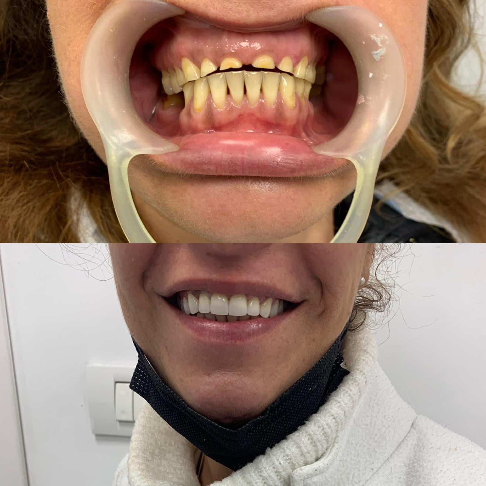 עקירת שיניים כלואות