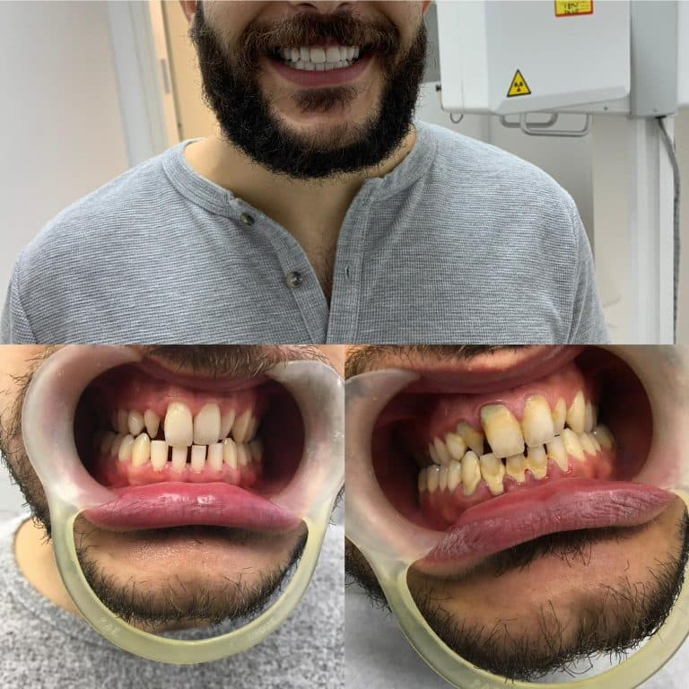 עקירות כירורגיות