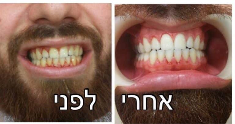 ציפוי שיניים חרסינה